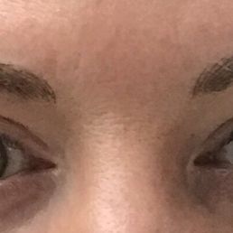 Right after procedure.