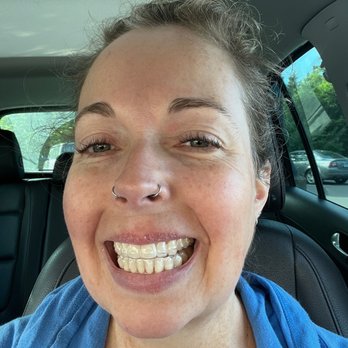 Progress Ridge Orthodontics - New trays pardon the chapped lips!! - Orthodontists Near Me - Beaverton, Oregon Progress Ridge Orthodontics - New trays pardon the chapped lips!! - Orthodontists Near Me - Beaverton, Oregon