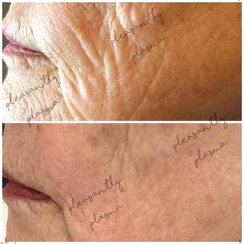 Pleasantly Plasma - Skin Care Near Me - Phoenix, Arizona Pleasantly Plasma - Skin Care Near Me - Phoenix, Arizona