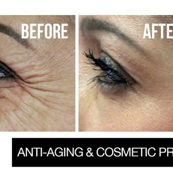 Inspire Med Spa - Wrinkle Reduction - Crows feet - Medical Spas Near Me - Lyndhurst, New Jersey Inspire Med Spa - Wrinkle Reduction - Crows feet - Medical Spas Near Me - Lyndhurst, New Jersey