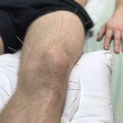 Healthlings - Treatment for patellar tendinitis.
