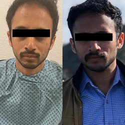 Hair Restoration and Aesthetics