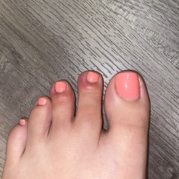 Toe infection Toe infection