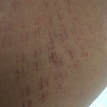 Gravity MedSpa - 5 days after the treatment - Medical Spas Near Me - San Juan Capistrano, California