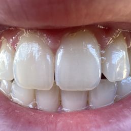 My front tooth implant with veneer on the tooth next to it. My front tooth implant with veneer on the tooth next to it.
