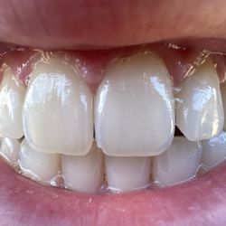 Cypress Dental Group - My front tooth implant with veneer on the tooth next to it.