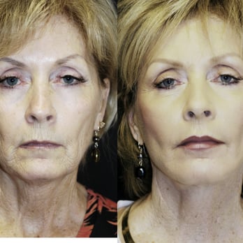 Sadove Cosmetic Surgery - Lower Face and Neck Lift with Laser by Sadove - Cosmetic Surgeons Near Me - Gainesville, Florida Sadove Cosmetic Surgery - Lower Face and Neck Lift with Laser by Sadove - Cosmetic Surgeons Near Me - Gainesville, Florida