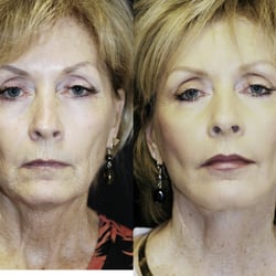 Sadove Cosmetic Surgery - Lower Face and Neck Lift with Laser by Sadove