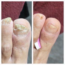 The Nail Industry Therapeutic Footcare - Toenail reconstruction