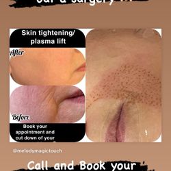Melody Magic Touch - This is a great technique for the ones who don't want a surgery to there face it's called a fibroblasts skin tightening. 313-442-6665
