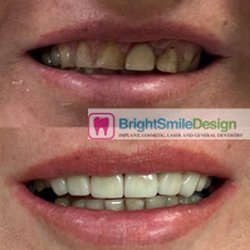 Bright Smile Design - Dental before/after shows significant smile improvement. Dental Veneers cosmetic/restorative work. Howell NJ