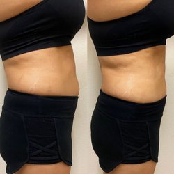 Essential Beauty Aesthetics - Ultrasonic cavitation and radiofrequency -1hr treatment