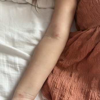 Children's Dermatology - Orange - This was the arm that previously had the most flare up. - Dermatologists Near Me - Orange, California