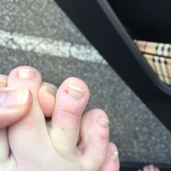 My Nails - Cut toe - 1 of 2 cuts. Toes in pain - Nail Salons Near Me - Cumming, Georgia My Nails - Cut toe - 1 of 2 cuts. Toes in pain - Nail Salons Near Me - Cumming, Georgia