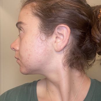 Morgan James Salon - Excuse my face and skin but this was the situation we were trying to fix.. the hair by the neck was super short and wouldn't go into a bun. - Hair Salons Near Me - Sunnyvale, California