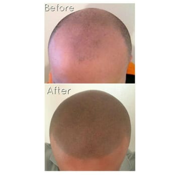 Scalp Micropigmentation Hair Replacement Tattoo Yelp