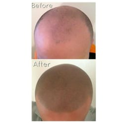 Utah Scalp Micropigmentation Center - Scalp micropigmentation, Hair replacement tattoo