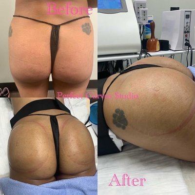 Non-Surgical Butt Enhancement - Non-invasive breast lift that lifts and tightens the skin around the breast tissue in a session.

Treatments are effective and safe in reducing sagging in the breast and the surrounding tissue.

Laser breast lifting involves a two-step process that induces the superficial tightening and deep tightening of the breast tissue.