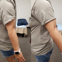 Deng Acupuncture and Herb - Frozen shoulder