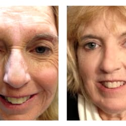 Olive Tree Aesthetic Studio - Before and after photo: Voluma to cheeks, Dysport to crows feet and frown area.