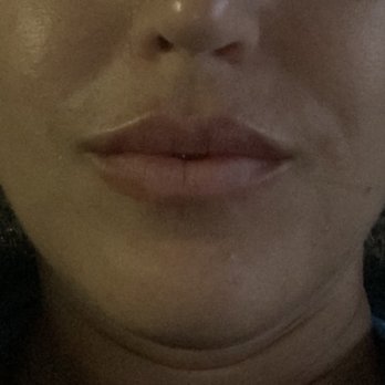 Pure Med Spa - 3 days after filler - Medical Spas Near Me - Chicago, Illinois Pure Med Spa - 3 days after filler - Medical Spas Near Me - Chicago, Illinois