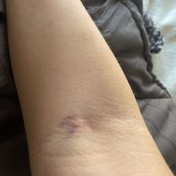 Emergency Room at Arizona General Hospital - Goodyear, AZ - Right arm blown vein, swollen and in pain. Went to the er for help and left worse.