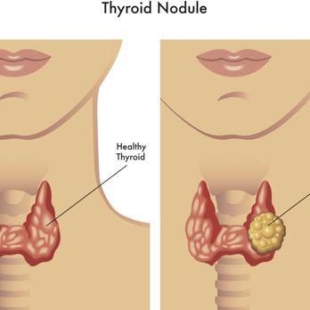 Core Health Solutions - Difference between healthy thyroid and inflamed - Weight Loss Centers Near Me - Chesapeake, Virginia Core Health Solutions - Difference between healthy thyroid and inflamed - Weight Loss Centers Near Me - Chesapeake, Virginia