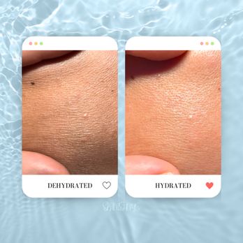 Skinishnyc - DEHYDRATED VS HYDRATED SKIN WITH HYDRAFACIAL - Day Spas Near Me - Bayside, New York Skinishnyc - DEHYDRATED VS HYDRATED SKIN WITH HYDRAFACIAL - Day Spas Near Me - Bayside, New York