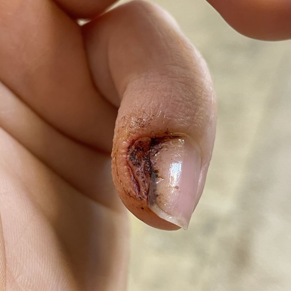 Venetien Nail - "Lovely" nail infection I got from the Venetien Salon - Nail Salons Near Me - Riverview, Florida