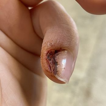 Venetien Nail - "Lovely" nail infection I got from the Venetien Salon - Nail Salons Near Me - Riverview, Florida