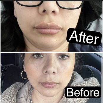 Lifted Aesthetics Charlotte - Medical Spas Near Me - Davidson, North Carolina