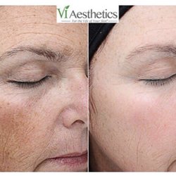 Beyond Brows - Who's ready for a good medical grade skin peel?