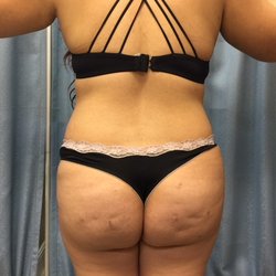 Gul A Zikria, MD FACOG - After Liposuction and Butt fat grafting
