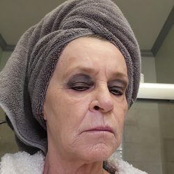 Winston Salem Dermatology - My jaes are hanging, lip fillers gone.