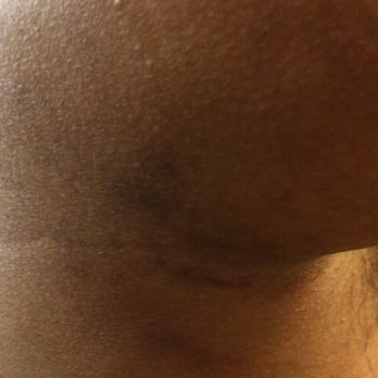 Green Foot - Bruises from massage that I got here. My right arm is in tremendous pain, and I am worried that masseuse has damaged my arm. - Massage Near Me - Milpitas, California