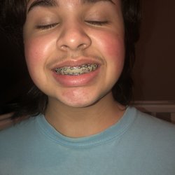 Robert Sheffield, DDS - Sheffield Orthodontics - During treatment