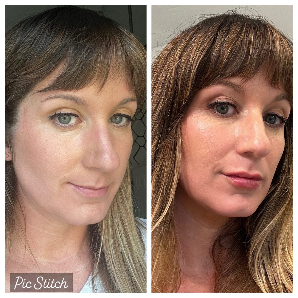 Iconic Plastic Surgery - Before and Immediately After Filler with Dr. Dsouza (20% swollen) - Cosmetic Surgeons Near Me - Carlsbad, California