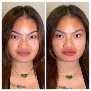 Revive Med Spa - Lip Filler Before and After - Medical Spas Near Me - Murphy, Texas