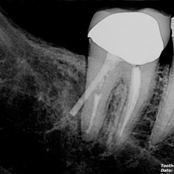 Apopka Dentist: Cristene Maas DDS - My poorly installed crown and post by Cristene Maas, DDS led to infection and eventually a lost tooth and implant.