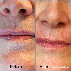 LYFT Facial Rejuvination - Lip & wrinkles filler