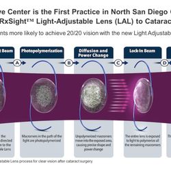 Davies Eye Center - How the Light Adjustable Lens works