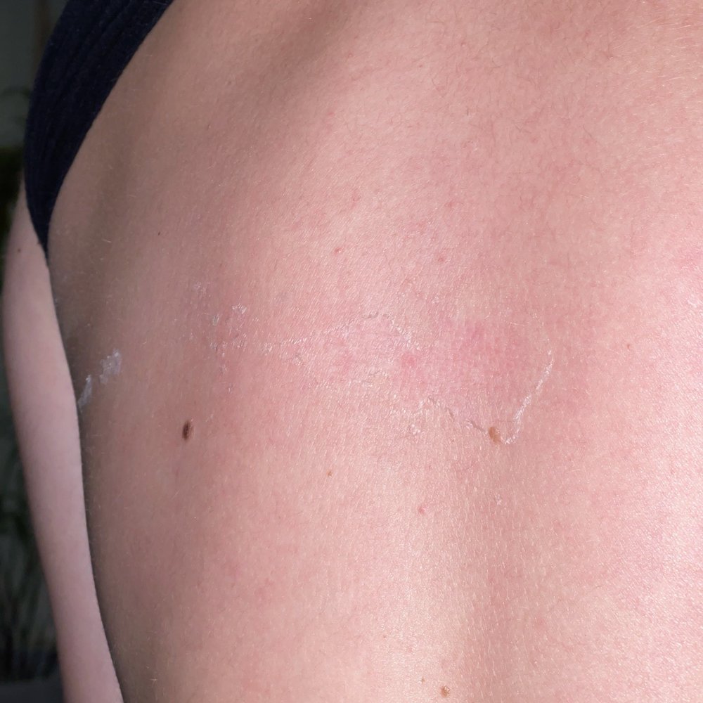 Bodyheat Tanning - BLISTERS AND BURN STARING TO PEEL - Tanning Near Me - Henderson, Nevada