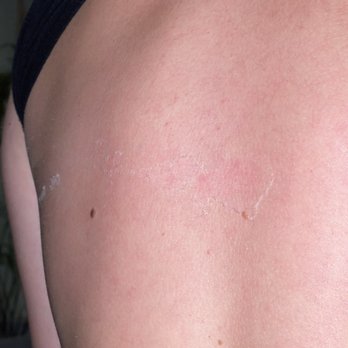 Bodyheat Tanning - BLISTERS AND BURN STARING TO PEEL - Tanning Near Me - Henderson, Nevada