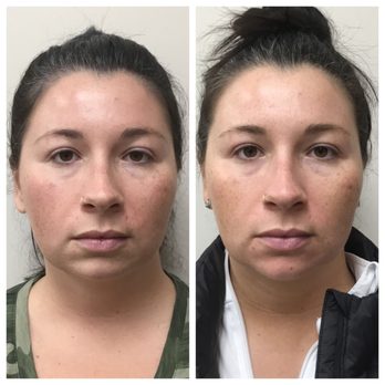 Cool Springs Plastic Surgery - Brentwood - Chin filler by Emily Findley - Cosmetic Surgeons Near Me - Brentwood, Tennessee Cool Springs Plastic Surgery - Brentwood - Chin filler by Emily Findley - Cosmetic Surgeons Near Me - Brentwood, Tennessee