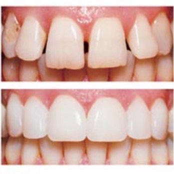 Dental Square - Porcelain veneers - Cosmetic Dentists Near Me - Mountain View, California Dental Square - Porcelain veneers - Cosmetic Dentists Near Me - Mountain View, California