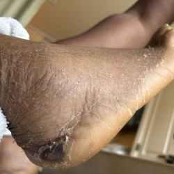 Lakes at Lutz Health and Rehabilitation Center - Bruise with no dressing. Discovered while cleaning our friend's feet.
