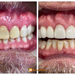 Soda City Smiles - Patient 1 before and after