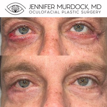 Jennifer Murdock, MD - Reconstructive surgery to correct complications from a previous cosmetic surgery performed elsewhere - Ophthalmologists Near Me - Miami, Florida