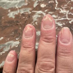 Nail infection.
