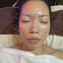 Acupuncture